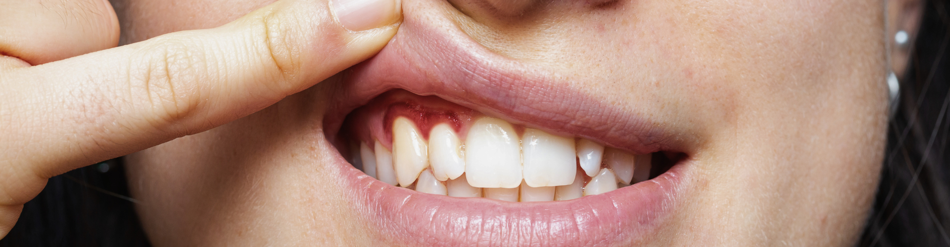 Woman lifting upper lip to show inflamed gums.